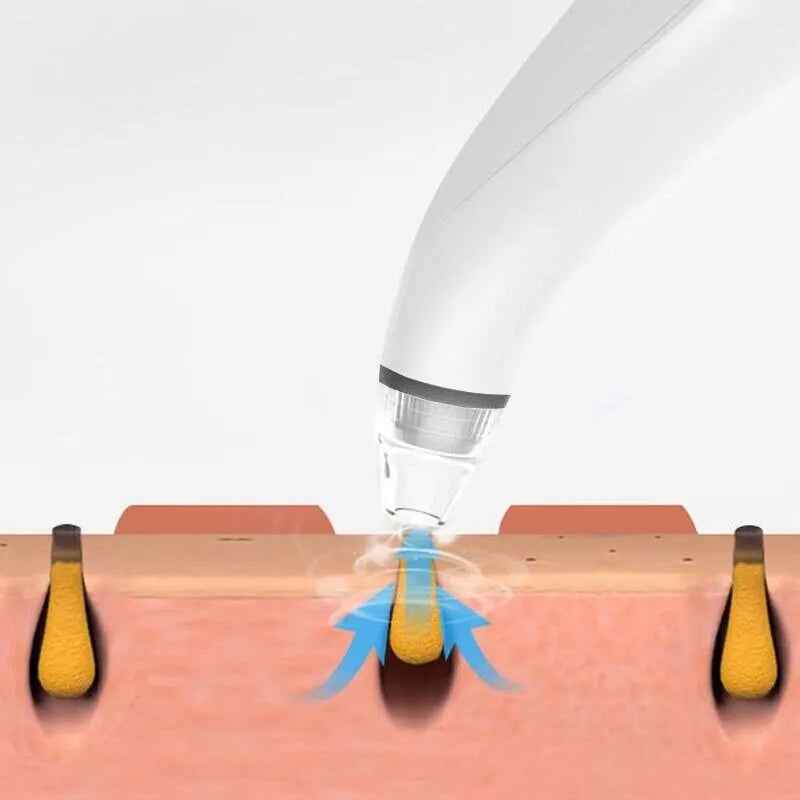 Electric Pore Vacuum Suction Blackhead Remover