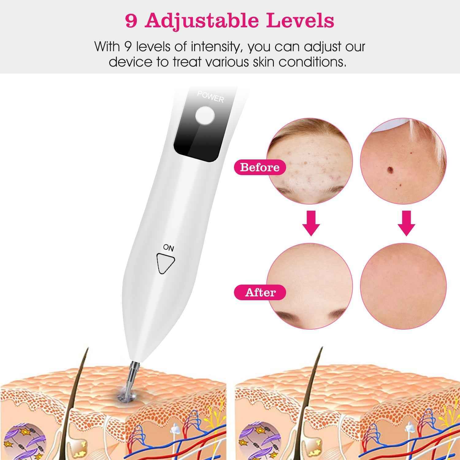 Rechargeable Acne Scar and Tag Remover Skin Repair Kit